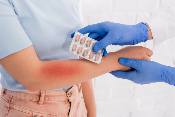 Ausgeschnittene Ansicht eines Arztes in Latexhandschuhen, der Tabletten in der Nähe einer Frau mit Allergie-Rötung am Arm hält  - Foto, Bild