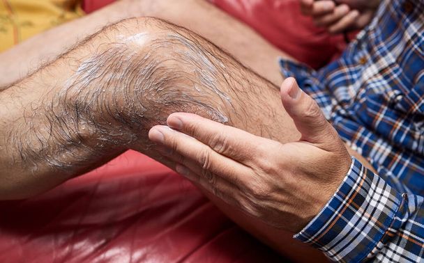 Man applying an anti-inflammatory ointment on a leg  - Photo, Image
