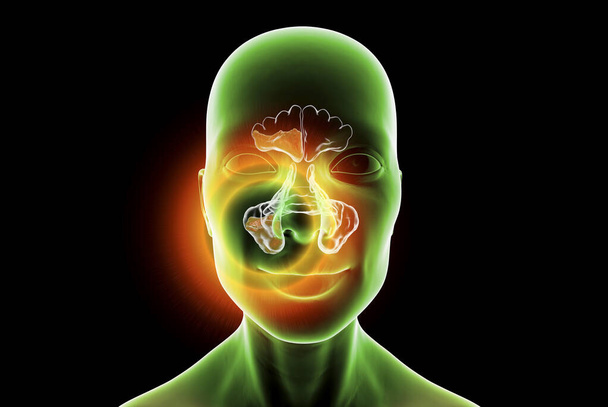 Sinusitis, inflamación de las cavidades paranasales. Ilustración 3D que muestra inflamación purulenta de los senos frontales y maxilares - Foto, Imagen