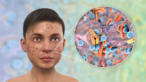 Acné, espinillas y vista de cerca de las bacterias, los agentes causales de las lesiones de la piel, ilustración 3D - Foto, Imagen