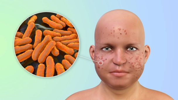 Acne vulgaris in an overweight person and closeup view of bacteria Cutibacterium acnes, formely formerly Propionibacterium acnes, associated with acne development, 3D illustration - Photo, Image
