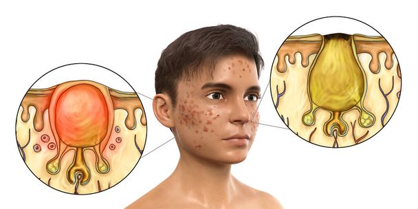 Akné vulgaris, kožní onemocnění vyskytující se při odumřelé kožní buňky a olej z kůže ucpání vlasové folikuly, 3D ilustrace dospívajícího chlapce a detailní pohled na akné bílé a černé komedony - Fotografie, Obrázek