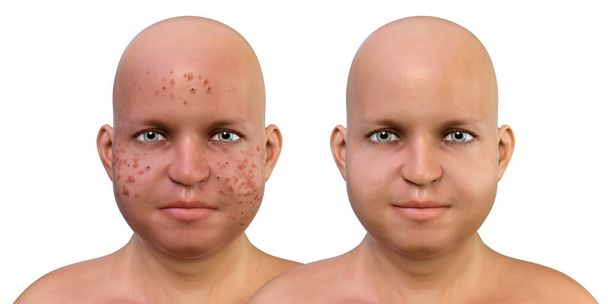 Akne vulgaris egy tinédzser túlsúlyos fiú, egy bőrbetegség fordul elő, amikor elhalt bőrsejtek és olaj a bőr eltömődött szőrtüszők, 3D-s illusztráció. Kezelés előtt és után - Fotó, kép