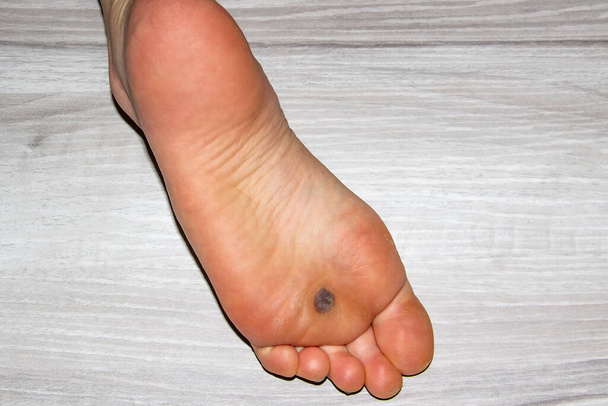 Жіноча нога з темним простором на нозі після того, як азот заморозив планярні бородавки через три тижні. - Фото, зображення