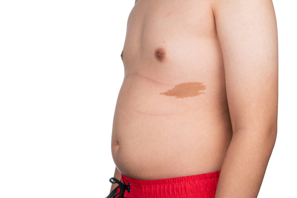 Nagy anyajegy az ázsiai fiú hasán. Közelkép a barna anyajegyről az ázsiai kövér fiún. - Fotó, kép