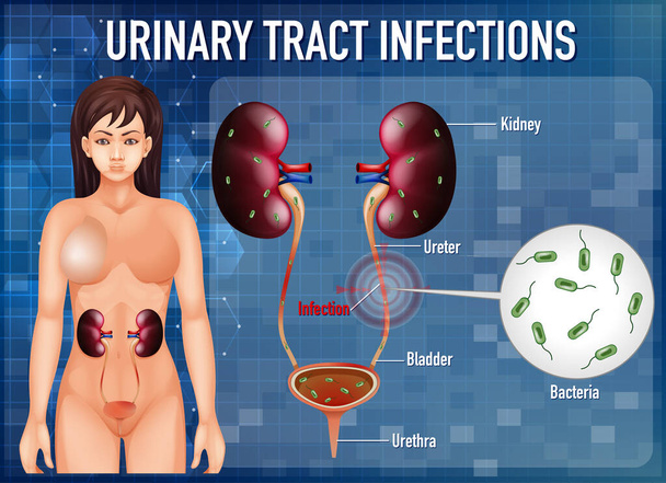 Manifesto informativo delle infezioni del tratto urinario illustrazione - Vettoriali, immagini