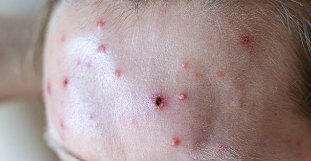Large spots and pimples acne on the body - adult body with chickenpox. man with Chickenpox, Varicella, Varicella Zoster Virus. - Photo, Image