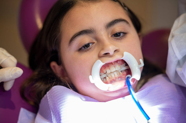 Het toepassen van beugels voor tanden op een schattig klein meisje in de tandarts studio, patiënt het dragen van een mond opening tool. - Foto, afbeelding