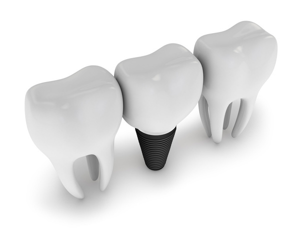 tooth implant - Photo, Image