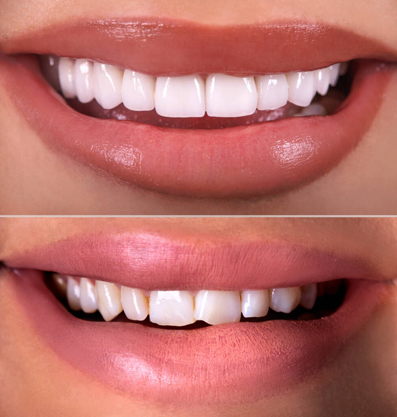 Täydellinen hymy ennen ja jälkeen valkaisu menettely valkaisuun zirkoni kaari keraaminen proteesi implantit kruunut. Hammashoitopotilas. Suukirurgian tulos hammaslääketiede, - Valokuva, kuva