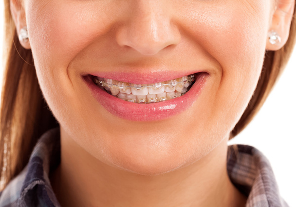 Mouth care teeth with braces  - Фото, зображення
