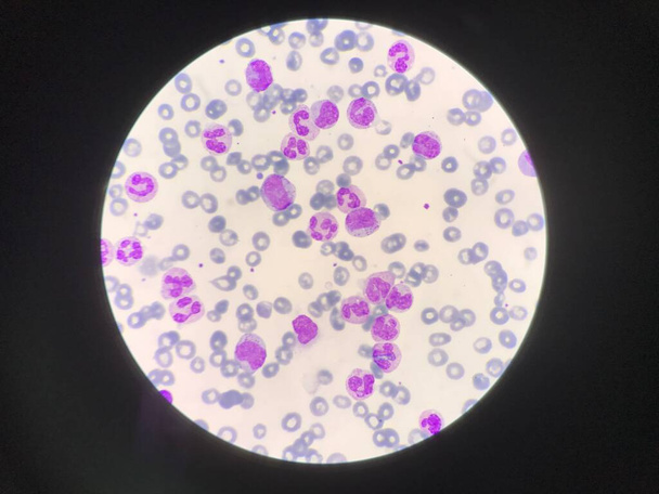 Незрелые и зрелые белые клетки крови. Сегментированный нейтрофил, миелоцит, метамиелоцит, форма группы. - Фото, изображение