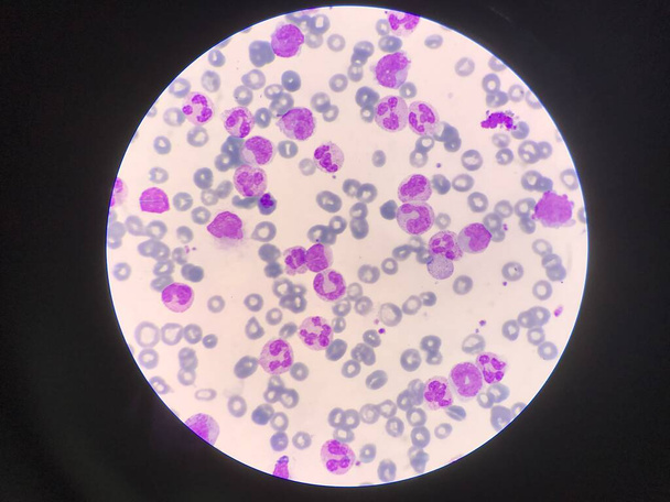 Unreife und reife weiße Blutkörperchen. Segmentierte Neutrophile, Blastzellen Myelozyten, Metamyelozyten, Bandbildung. - Foto, Bild
