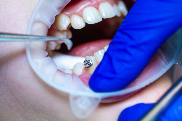 Κοντινό πλάνο των δοντιών με στηρίγματα μωρών σε ραντεβού με οδοντίατρο σε οδοντιατρική κλινική, τοποθέτηση τιράντες κλειδαριές στα δόντια και το τράβηγμα της τοξοειδούς σύρματος για να το διορθώσετε. - Φωτογραφία, εικόνα