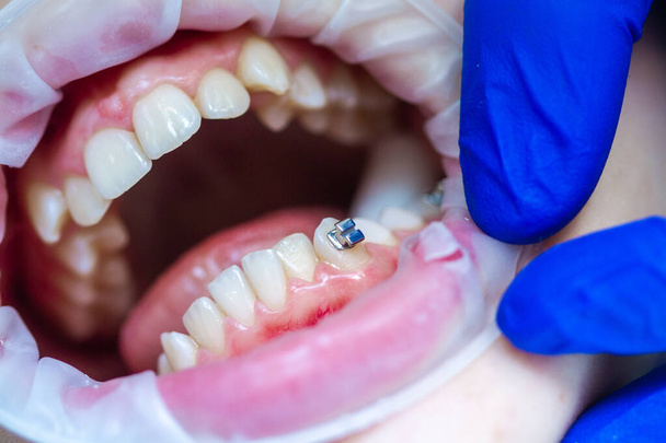 Κοντινό πλάνο των δοντιών με στηρίγματα μωρών σε ραντεβού με οδοντίατρο σε οδοντιατρική κλινική, τοποθέτηση τιράντες κλειδαριές στα δόντια και το τράβηγμα της τοξοειδούς σύρματος για να το διορθώσετε. - Φωτογραφία, εικόνα