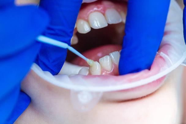 Behandlung und Ausrichtung der Zähne, zahnärztliche Behandlung - Foto, Bild