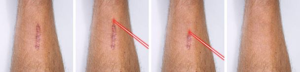 Tratamiento de sesión de eliminación de láser cicatriz. Antes y después. Revitalización láser de cicatrices, cirugía láser. - Foto, Imagen