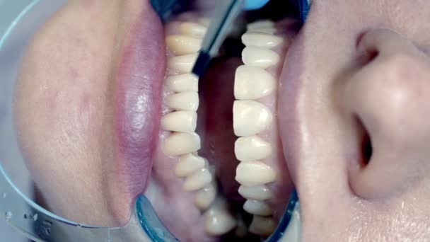 Klinikte diş beyazlatma - Video, Çekim