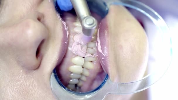 Wybielanie zębów w klinice - Materiał filmowy, wideo