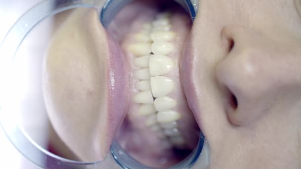 Отбеливание зубов в клинике - Кадры, видео