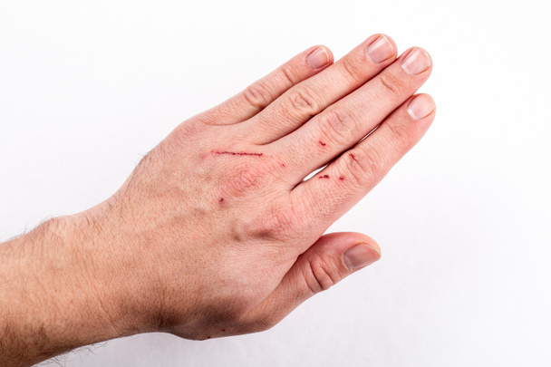 Cicatrizes e lesões em um homem dedos. acidente, lesão ou ataque de um gato - Foto, Imagem