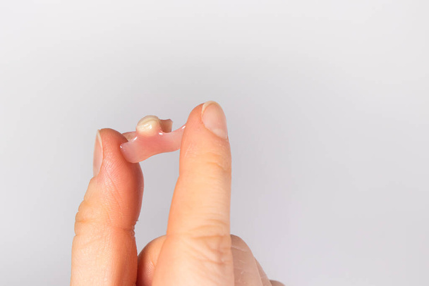 Artificial tooth prosthesis in a person's hand. Single removable prosthesis to replace a real tooth, an alternative to dental implantation in dentistry. - Photo, Image