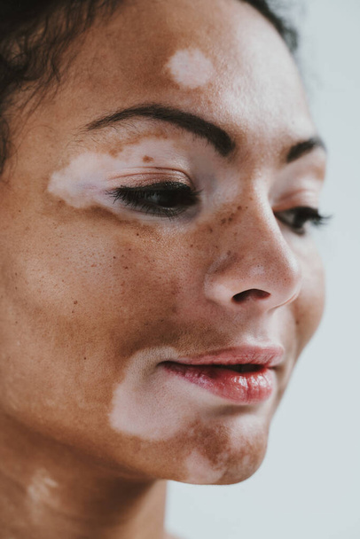 Beautiful woman with vitiligo skin posing in studio. Concept about body positivity and self acceptance - Фото, зображення
