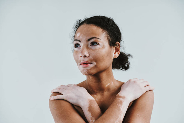 Beautiful woman with vitiligo skin posing in studio. Concept about body positivity and self acceptance - Foto, Imagen