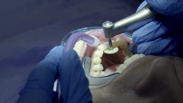 pulido de dientes en el dentista - Imágenes, Vídeo