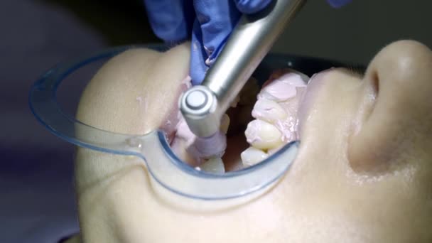 blanqueamiento dental en el dentista - Imágenes, Vídeo