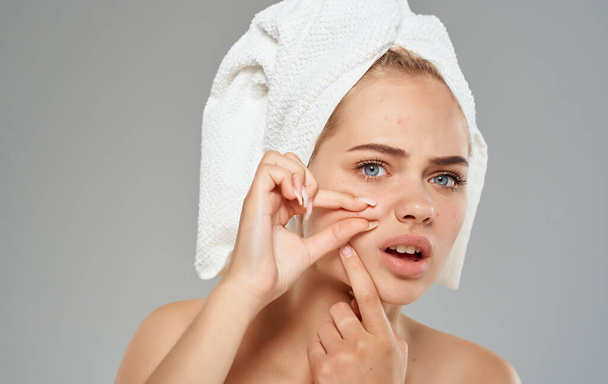 Косметологія дерматологія жінка з рушником на голові акне на її обличчі
 - Фото, зображення