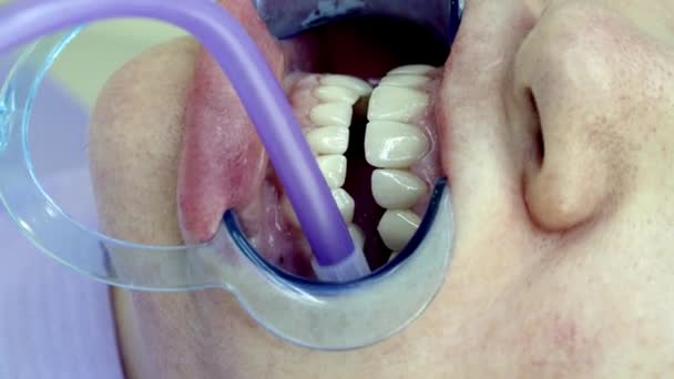 montaż oklein dentystycznych w klinice - Materiał filmowy, wideo