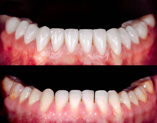 Perfect smile before and after bleaching procedure whitening of zircon arch ceramic prothesis Implants crowns. Dental restoration treatment clinic patient. Result of oral surgery dentistry, - Photo, Image