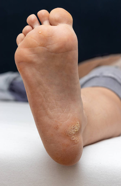 Cornea boven Plantaire wrat op de bodem van een vrouwelijke voet hiel veroorzaakt door het humaan papillomavirus, of HPV. Selectieve focus. - Foto, afbeelding
