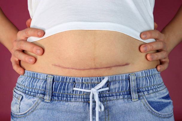 mujer muestra la cicatriz de la cesárea en el estómago - Foto, Imagen