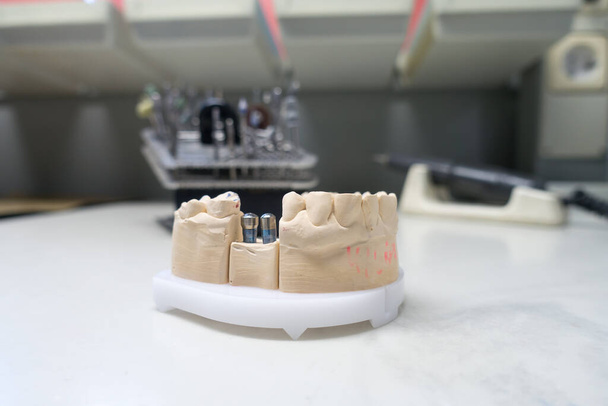 gips model van de menselijke kaak met tandheelkundige implantaten - Foto, afbeelding