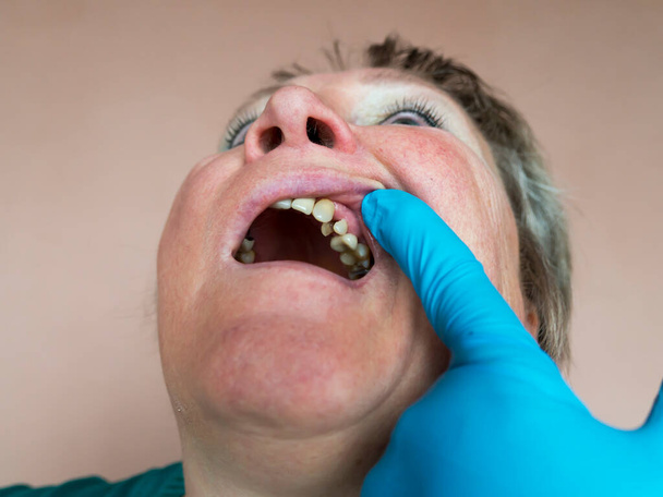 Práctica dental. El proceso de preparación de los dientes de la mandíbula superior para prótesis. Tratamiento, llenado, procesamiento para la instalación de coronas. Examen médico. - Foto, Imagen