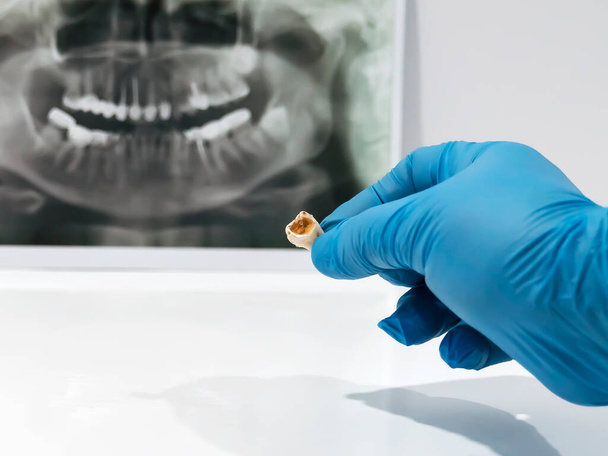 歯医者は抽出された歯を調べ、示します。背景には3D写真があります。手袋をして手。歯科医。手術. - 写真・画像