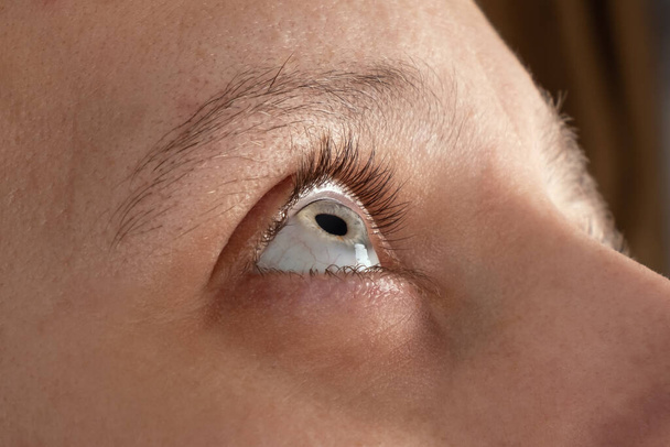žena oko s dystrofií rohovky, keratoconus, ztenčení rohovky - Fotografie, Obrázek