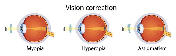 Correction of various eye vision disorders by lens. Hyperopia, myopia, astigmatism. Vector illustration - Vector, Image