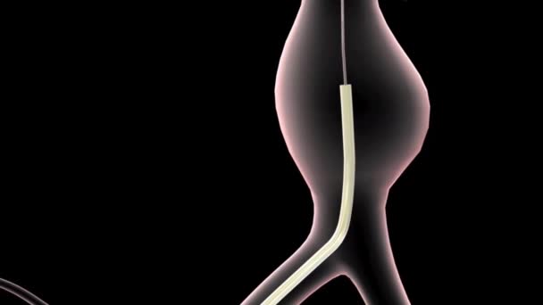Large Abdominal Aortic Aneurysm .3D Animation - Footage, Video