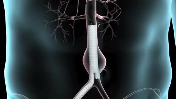 Nagy hasi aorta aneurizma .3D animáció - Felvétel, videó