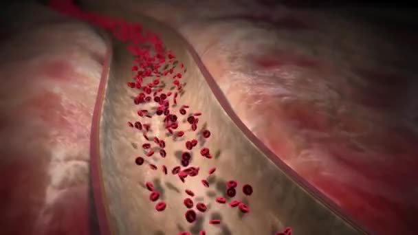 ステントカテーテルと血管形成術 - 映像、動画