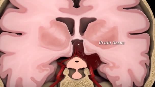 Легкая травма головного мозга может временно повлиять на клетки мозга. Более серьезная травма головного мозга может привести к синякам, разрыву тканей, кровотечению и другим физическим повреждениям мозга.  - Кадры, видео