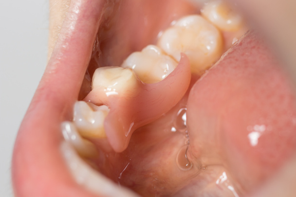 Sztuczna proteza zęba w ustach pacjenta. Umieścił w stomatologii sztuczny trzonowiec. - Zdjęcie, obraz