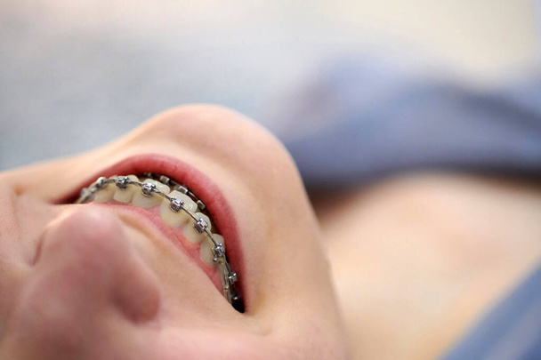 Glimlachende jonge vrouw met beugels op tanden dicht. Metalen zelflikkende tandbeugels. - Foto, afbeelding