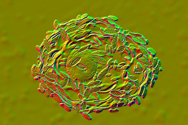 Бактеріальний вагіноз. 3D ілюстрації, що показують епітеліальні клітини, покриті бактеріями Gardnerella vaginalis, так звані клітини ключів, знайдені у вагінальному мазку, 3D ілюстрація
 - Фото, зображення