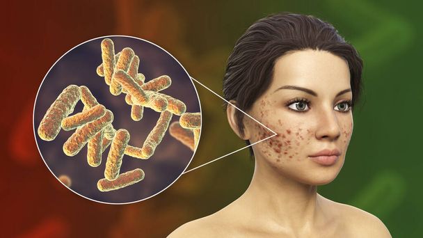 Acné vulgaris sur la peau et vue rapprochée des bactéries associées au développement de l'acné, illustration 3D - Photo, image
