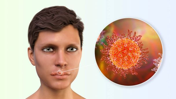 Herpes labialis, also known as cold sores, 3D illustration showing lesions on the man's lips caused by herpes simplex virus and closeup view of the virus - Photo, Image