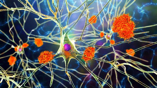Neuronen bij de ziekte van Alzheimer. 3D illustratie met amyloïde plaques in hersenweefsel, neurofibrillaire wartels en de opbouw van neuronale netwerken - Foto, afbeelding